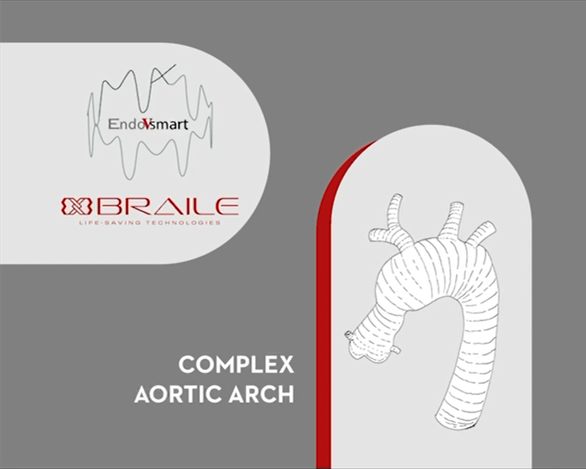 Complex Aortic Arch Case Study Thumbnail